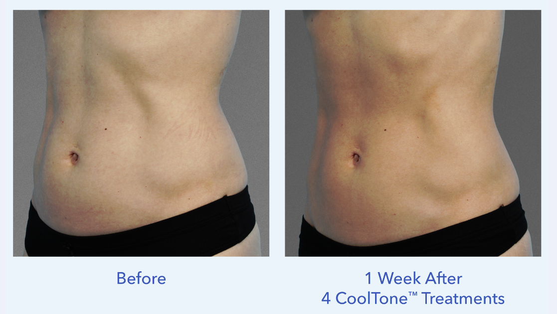 Dr. Bonness administers safe CoolTone treatments to women who want flatter stomachs fast