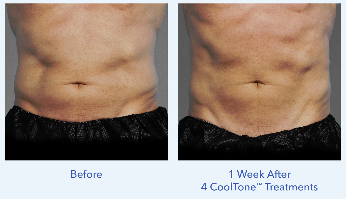 CoolTone is for men who want flatter stomachs and more defined abs
