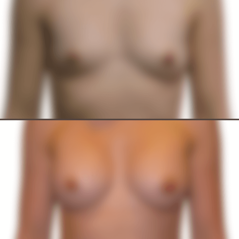 Breast augmentation before and after