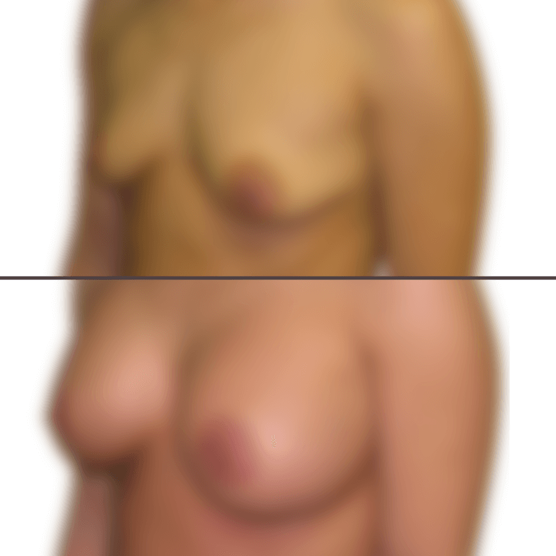 Breast augmentation before and after
