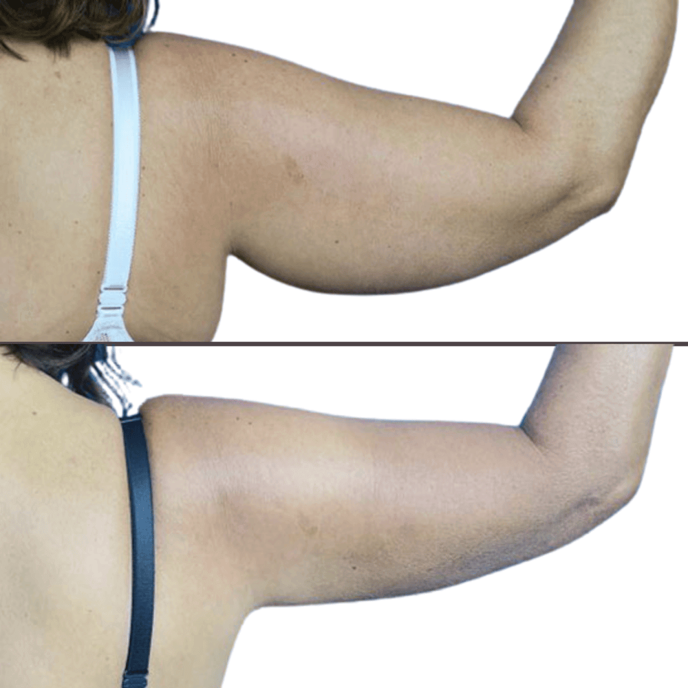 Liposuction before and after