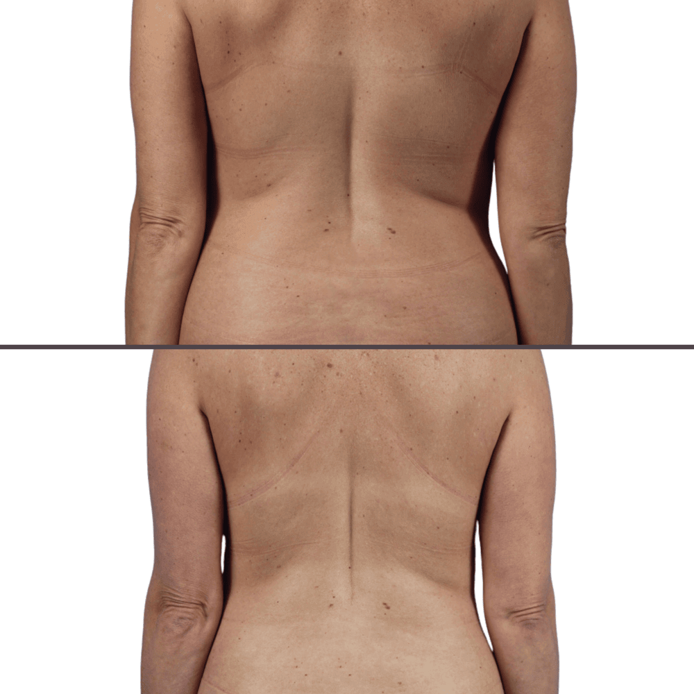 Liposuction before and after