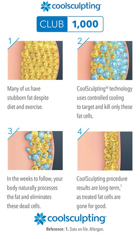 Coolsculpting Club 1000 Achievement