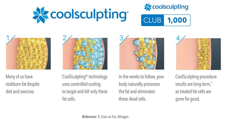 Coolsculpting Club 1000 Achievement