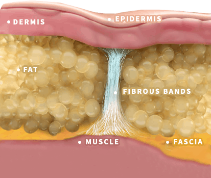 Rumored Buzz on Guide To Cellulite Reducing Foods - Realbuzz.com thumbnail