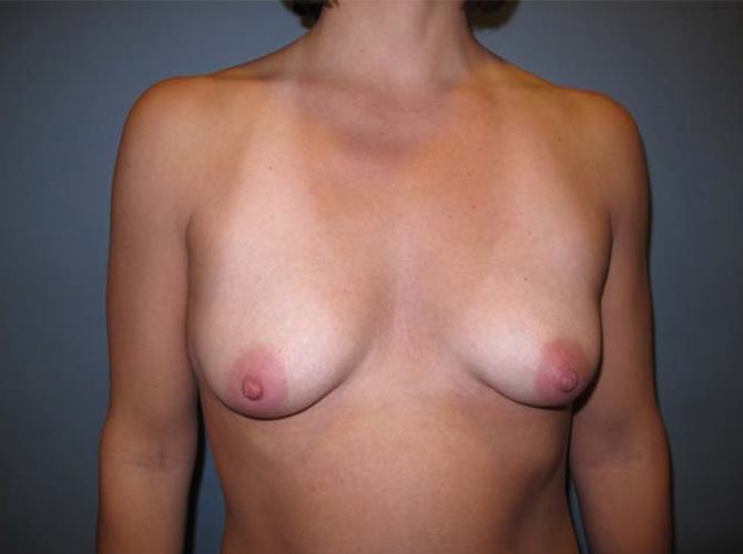 Before treatment: Breast Implants Milwaukee WI
