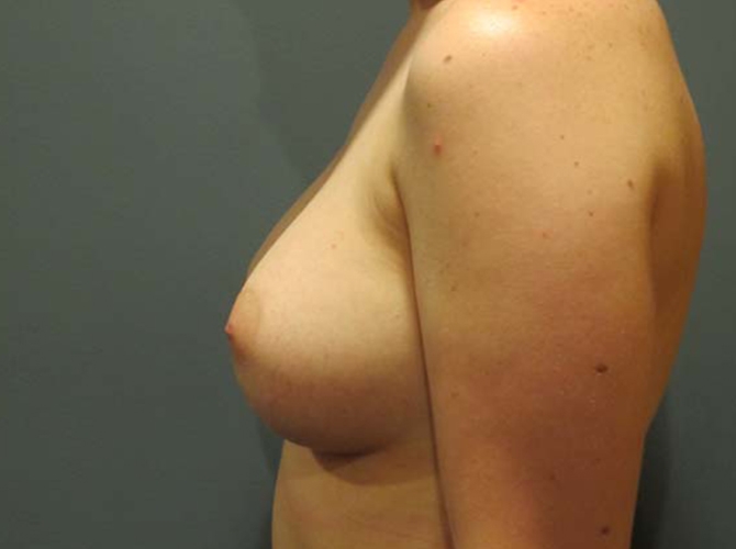 After treatment: Breast Augmentation Milwaukee