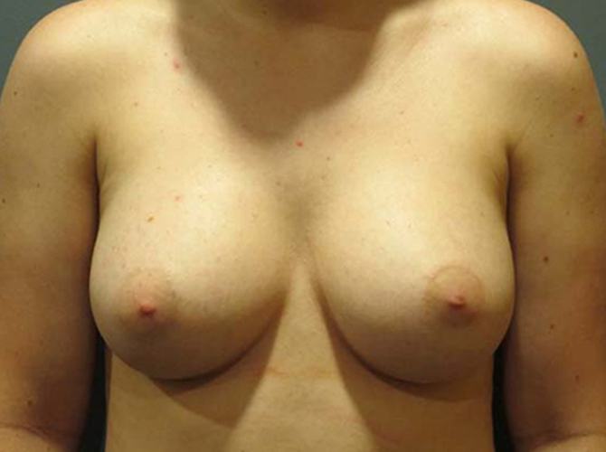 After treatment: Breast Implants Milwaukee