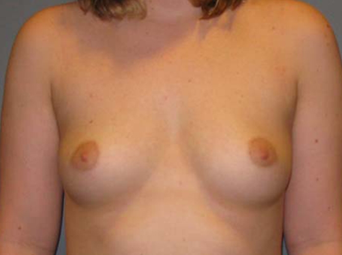 Before treatment: Breast Implants Milwaukee