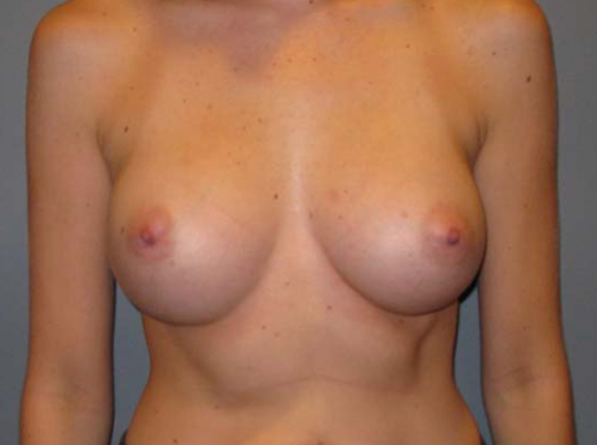 After treatment: Breast Surgery Waukesha Area