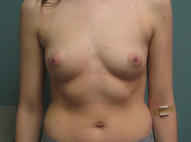 Before treatment: Breast Surgery Waukesha Area