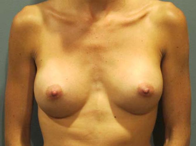 After treatment: Breast Implants Brookfield WI Patient Transformation