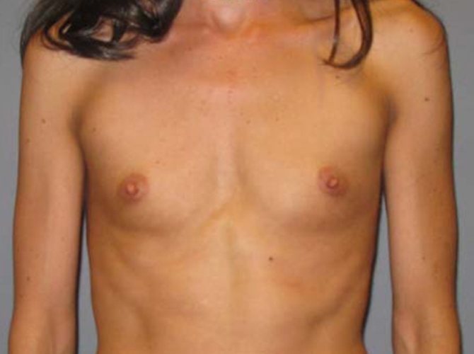 Before treatment: Breast Implants Brookfield WI Patient Transformation