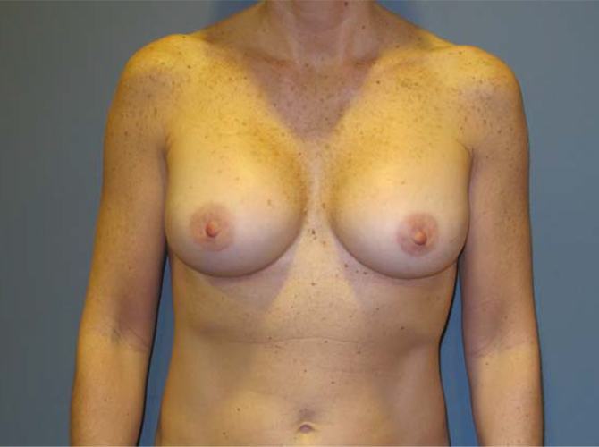 After treatment: Breast Implants Waukesha WI