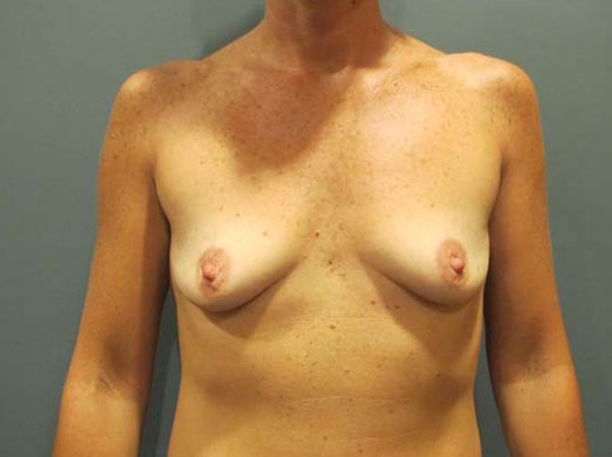 Before treatment: Breast Implants Waukesha WI