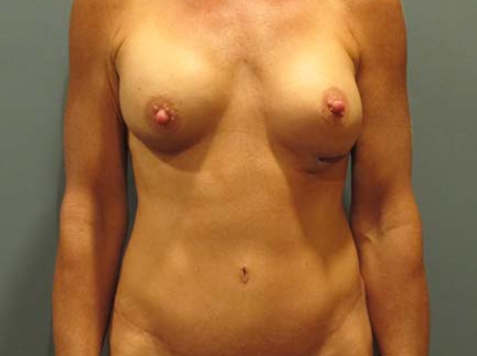 After treatment: Tummy Tuck Waukesha