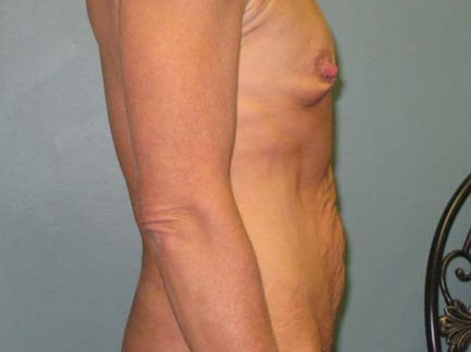 Before treatment: Stomach Skin Tightning Milwaukee