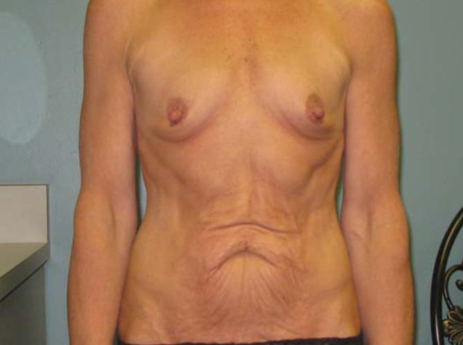 Before treatment: Tummy Tuck Waukesha