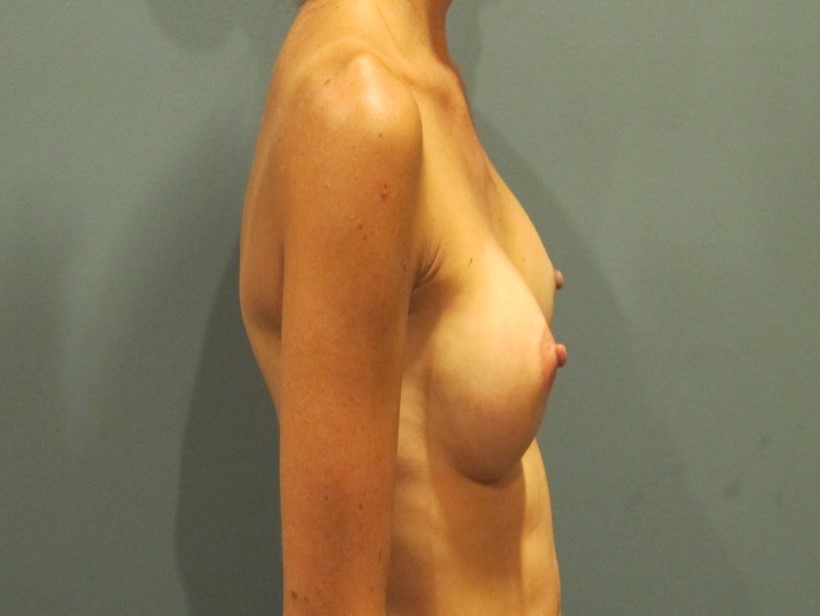 After treatment: Breast Augmentation Brookfield