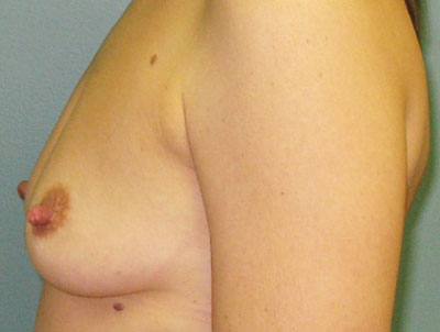 Before treatment: Breast Implants Franklin, WI