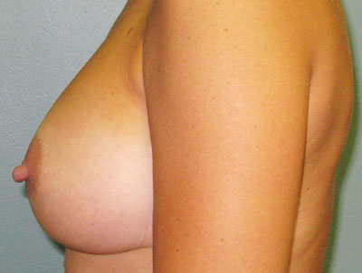 After treatment: Breast Implants Franklin, WI
