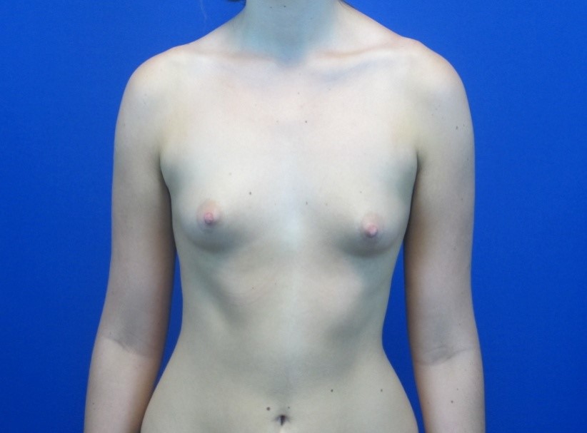 Before treatment: Breast Augmentation Surgery Milwaukee