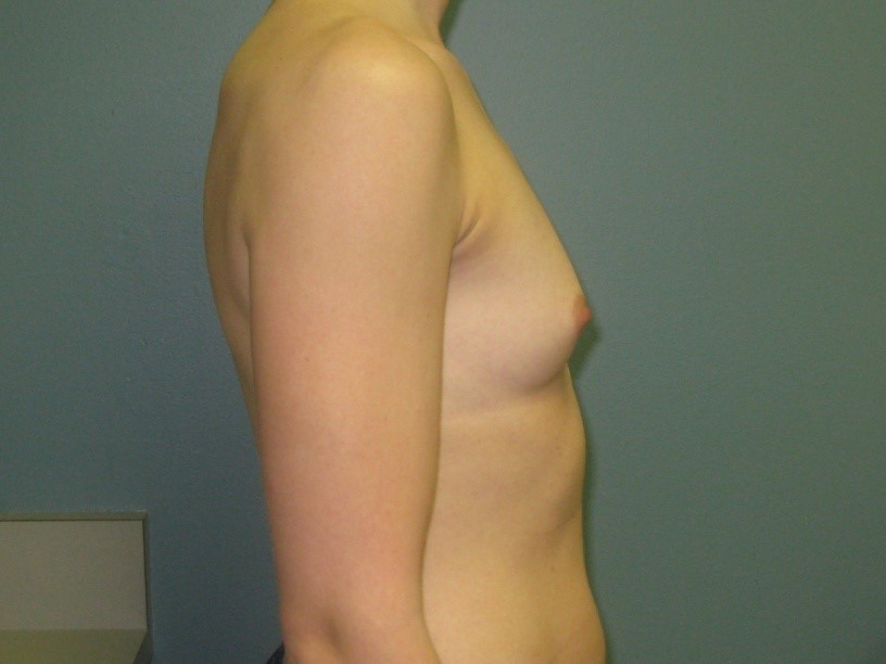 Before treatment: Breast augmentation in Oak Creek performed by Dr. Bonness