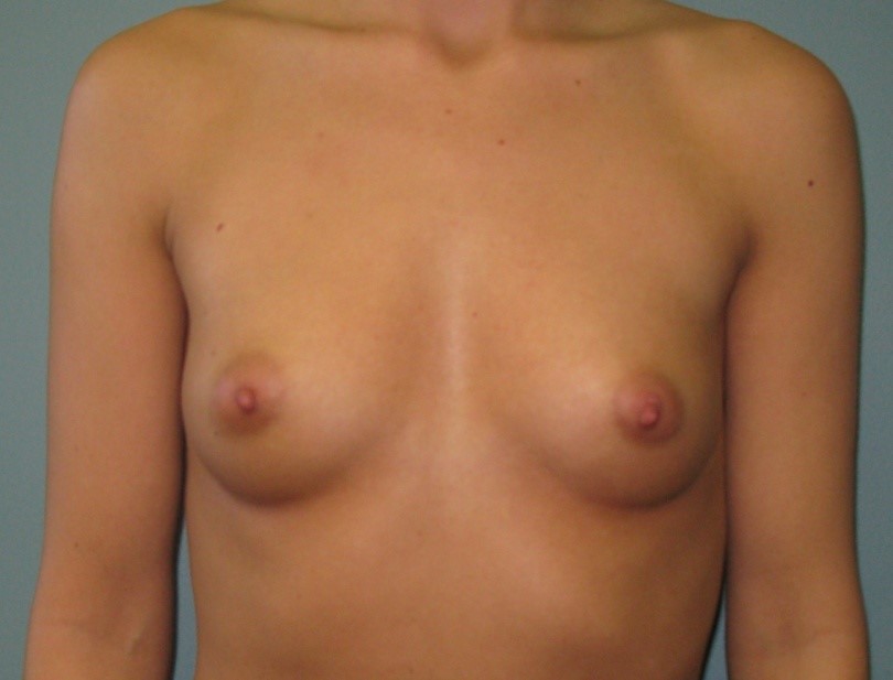 Before treatment: Breast Augmentation Surgery Sussex WI