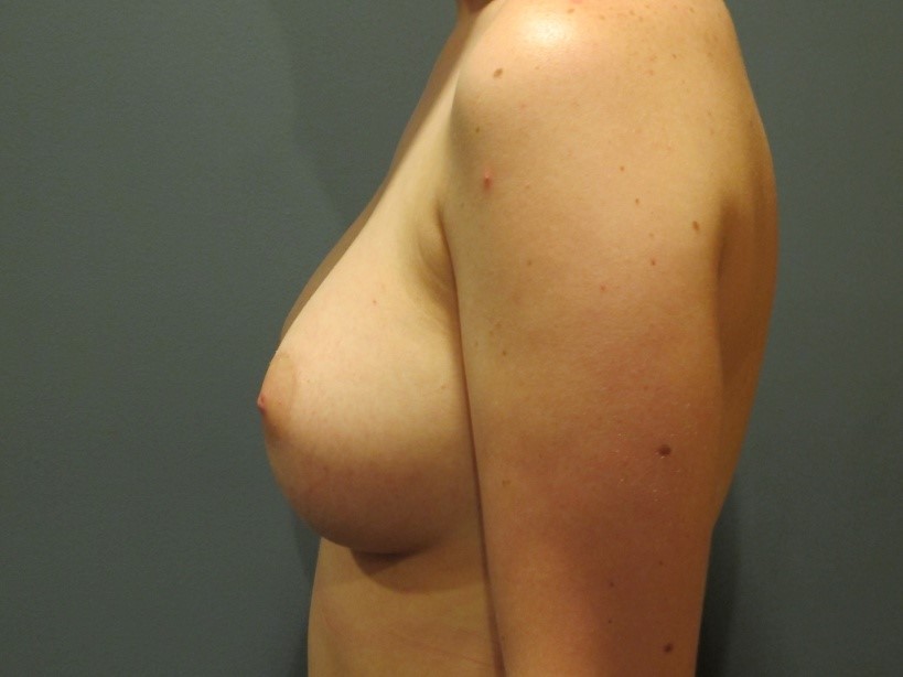 After treatment: Breast Augmentation Surgery Waukesha
