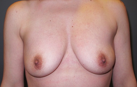 Before treatment: Breast Enhancement Menomonee Falls, WI Patient Transformation