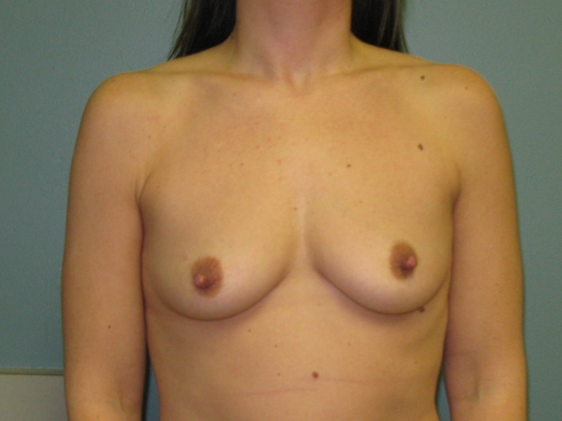 Before treatment: Mommy Makeover Breast Enhancement Mukwonago