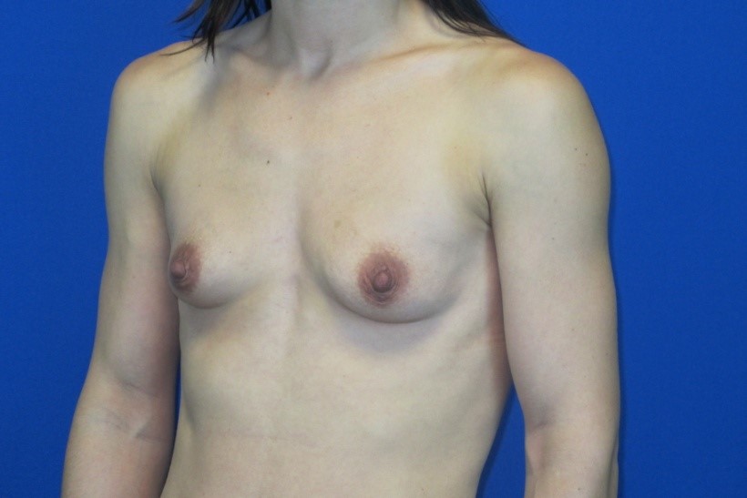 Before treatment: West Bend Breast Enhancement Surgery