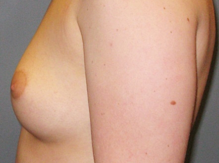 Before treatment: Breast Implants Greenfield, WI Patient Transformation