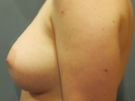 After treatment: Breast Implants Greenfield, WI Patient Transformation