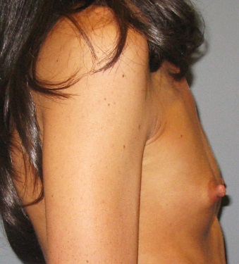Before treatment: Breast Implants Hartford, WI Patient Transformation