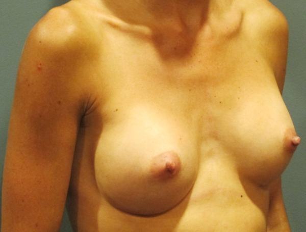 After treatment: Breast Implants Hartford, WI Patient Transformation