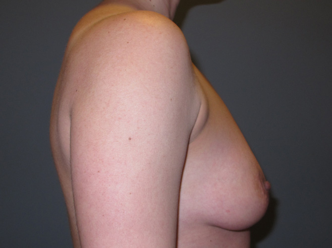 Before treatment: Breast Implants Menomonee Falls WI