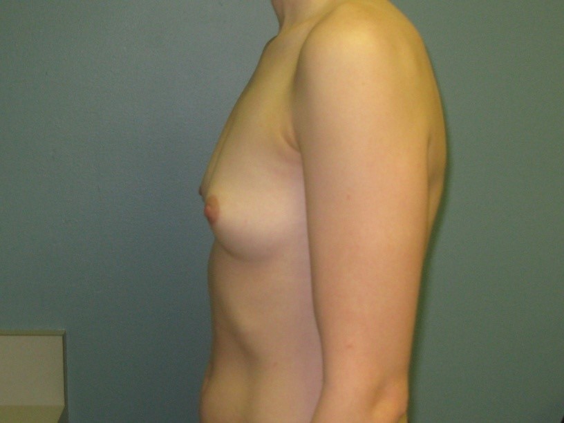 Before treatment: Breast Implants Mequon