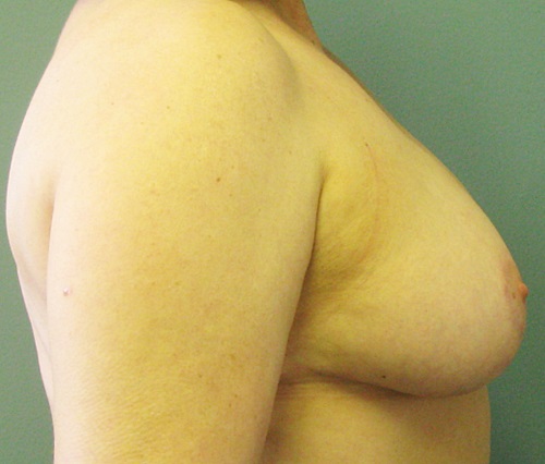After treatment: Breast Reduction Germantown, WI Patient Transformation
