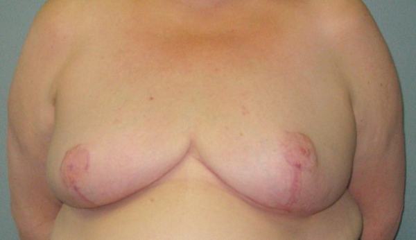 After treatment: Breast Reduction Greendale, WI Patient Transformation