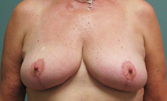After treatment: Breast Reduction Oconomowoc, WI Patient Transformation
