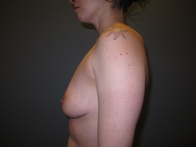 Before treatment: Breast Augmentation Surgery Milwaukee