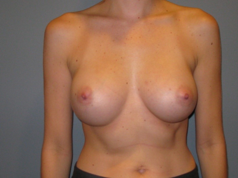 After treatment: Breast Surgery West Bend