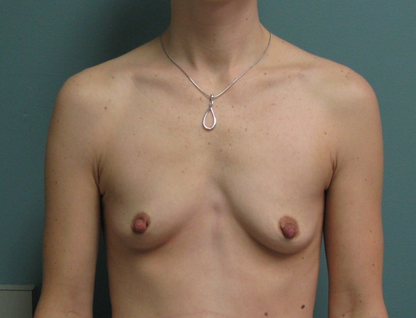Before treatment: Cosmetic Breast Enhancement Greenfield WI
