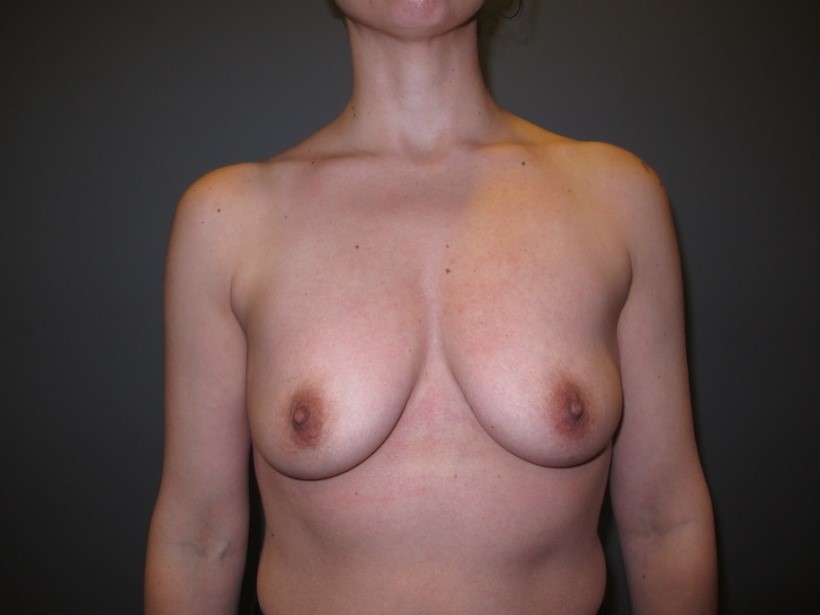 Before treatment: Cosmetic Breast Enhancement Hartland WI