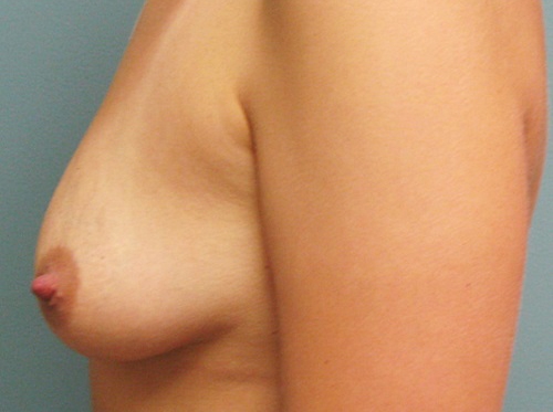 Before treatment: Cosmetic Breast Enhancement Menomonee Falls, WI Patient Transformation
