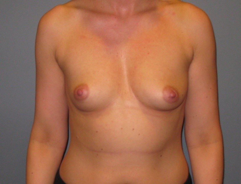 Before treatment: Sheboygan Cosmetic Breast Enhancement