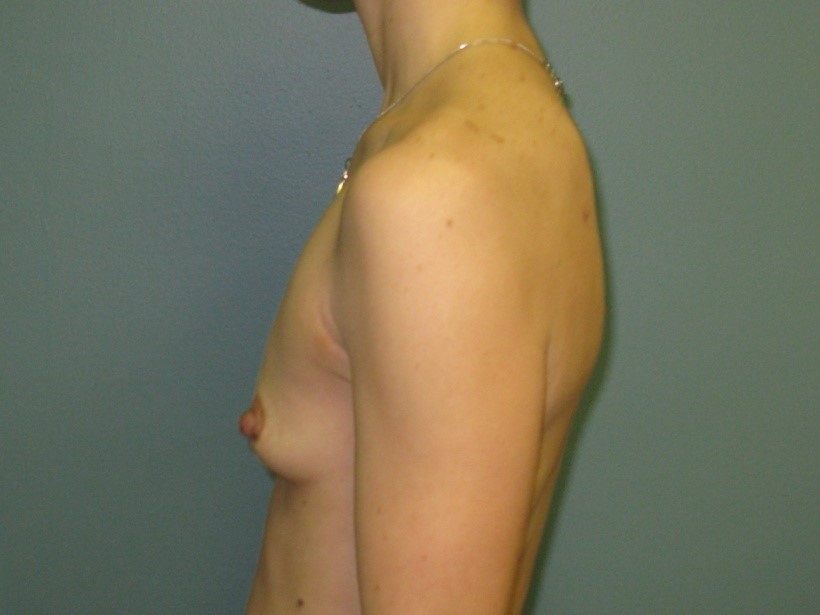Before treatment: Burlington Cosmetic Breast Surgery