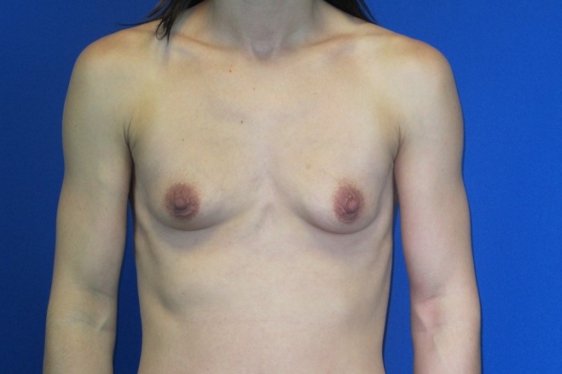 Before treatment: Cosmetic Breast Surgery Greenfield WI