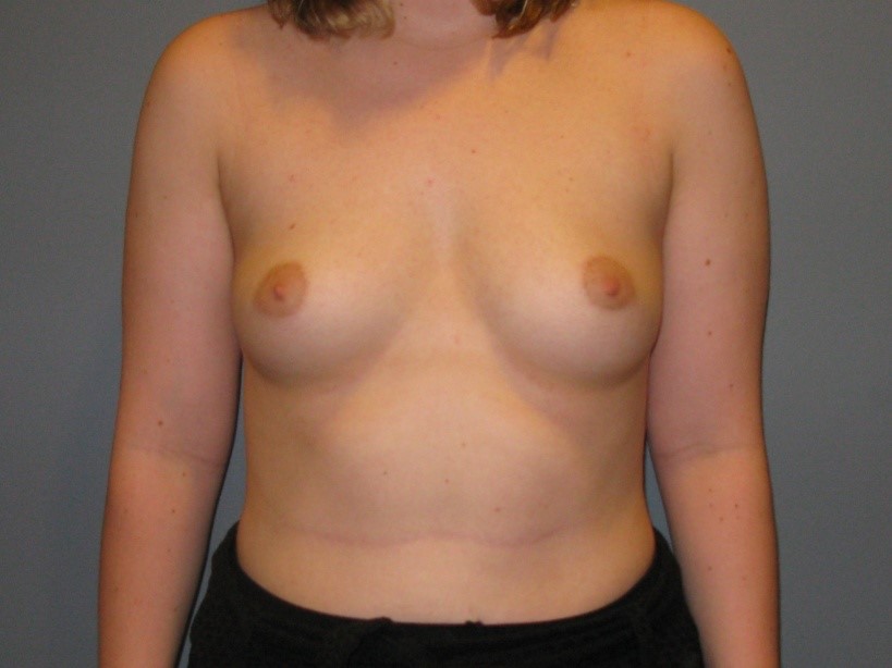 Before treatment: Cosmetic Breast Surgery Hartland